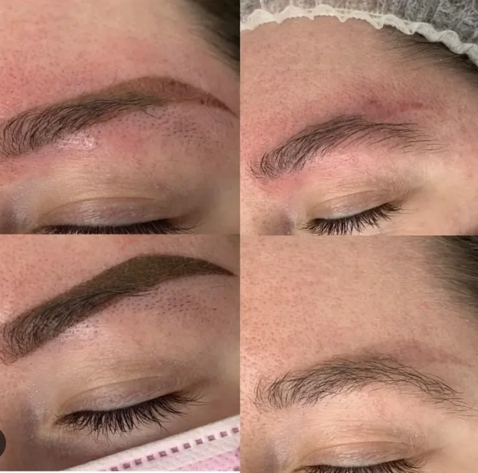 non-laser glycolic acid removal result Prescott Arizona