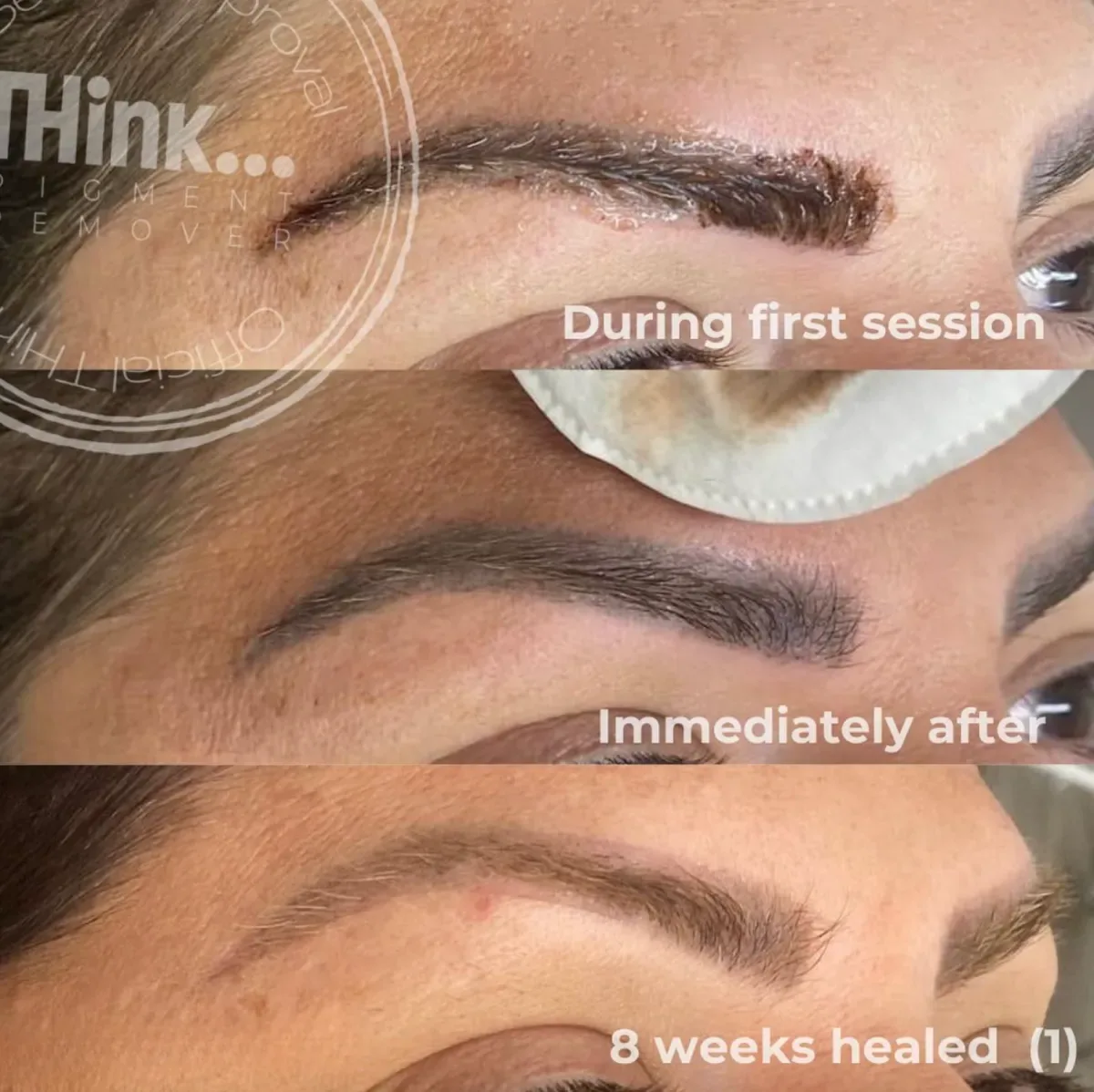 Brow tattoo removal result Yavapai County