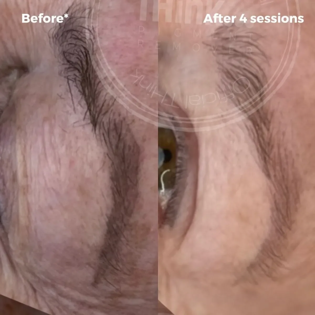 Microblading removal Prescott